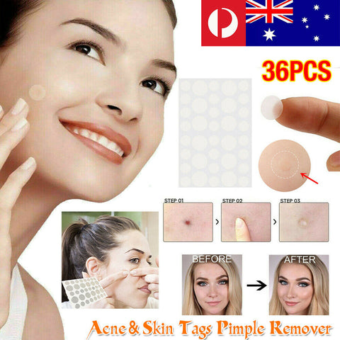 36Pcs Dermopatchy Acne Skin Tag Pimple Remover Patch Removal Facial Care Spot