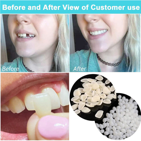 70pcs/box Temporary Crowns Posteriors Anteri Molar Resin Tooth Teeth Caps Dental